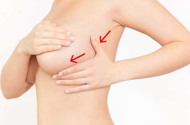 スペンス乳腺について説明するイメージ画像