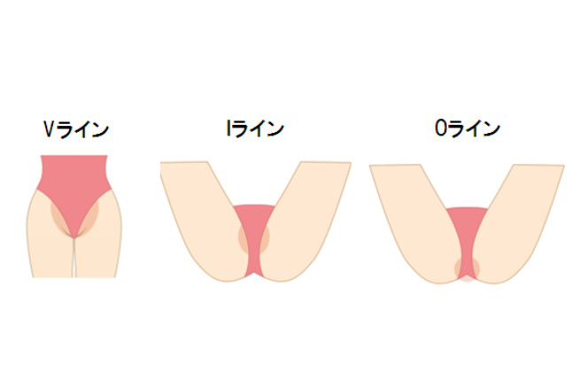 VIOも処理が大切を表わしたイメージ画像