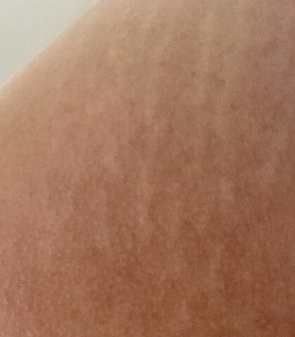 妊娠線、肉割れの画像